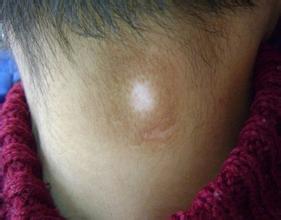 哪种女性最容易得白癜风