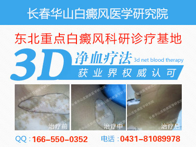 长春哪里治疗白癜风最好
